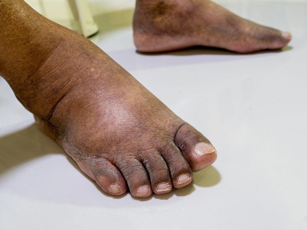 Why A Foot And Ankle Doctor Should Handle A Diabetic s Foot Care Needs