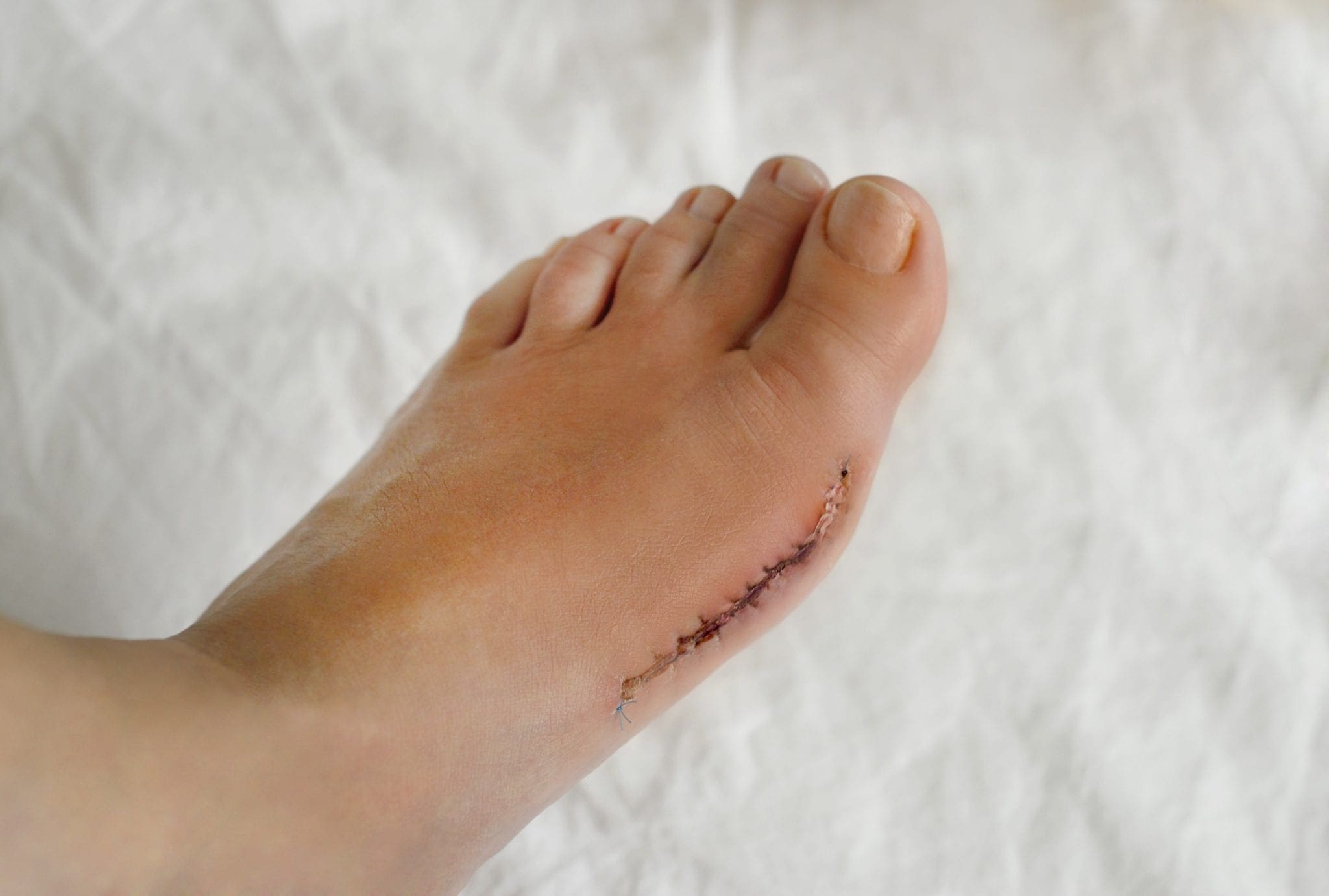 foot after bunion surgery