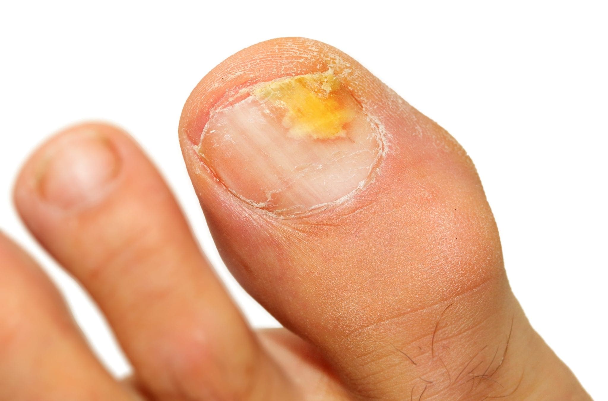 foot nail fungus hogyan kell kezelni