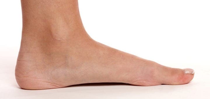 Flat Feet: Problems, Diagnosis, and Natural Remedies